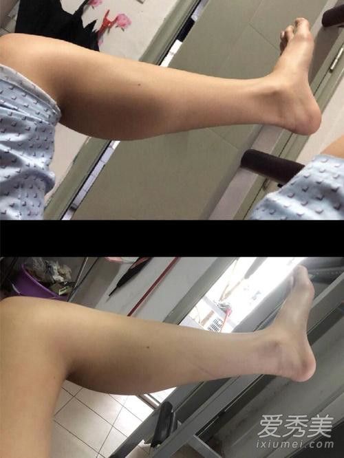 瘦腿针反弹后会更粗吗，真相解析与应对策略，瘦腿针反弹后是否会变得更粗？真相解析、应对策略全解析。
